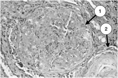 Renal Involvement in Antiphospholipid Syndrome